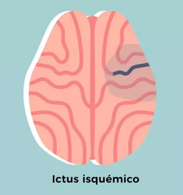 tipos de ictus isquémico - Aendyd